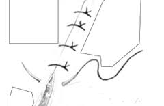 Image result for simple continuous suture pattern