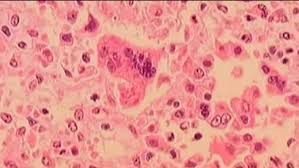 Measles Outbreak in the US: Tracking Cases and Prevention