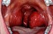 Red tonsils