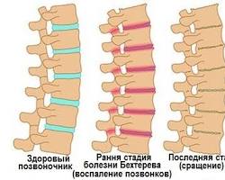 Воспаление, связанное с болезнью Бехтерева