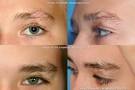 Eyebrow regrowth