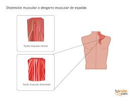 Resultado de imagen para distensión primeros auxilios