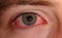 Coxsackie virus conjunctivitis