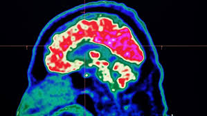 Groundbreaking Discovery: Montreal Researchers Uncover Genetic Mutation Behind Mirror Motion Syndrome