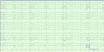 Burst suppression eeg