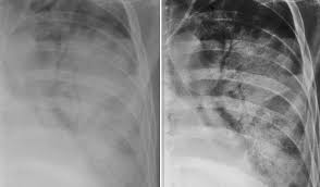 Image result for Air Bronchogram