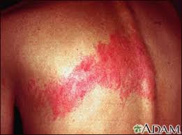 Image result for "Herpes Zoster"