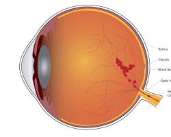 Image of Retinal vein occlusion eye