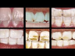Image result for fluorosis