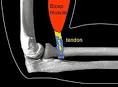 Physiotherapy in Sidney for Elbow Pain - Distal Biceps Rupture