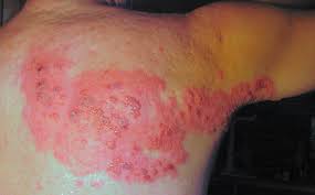 Image result for "Herpes Zoster"