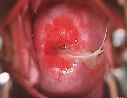 Image result for IUD image