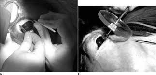 Image result for eyeball enucleation cattle