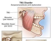 Image of TMJ disorder