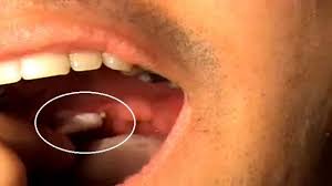 Image result for tonsil stones