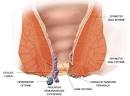 Hmorrodes : laposhomopathie pour les soulager - m