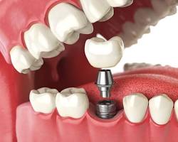 Dental implant crown placement