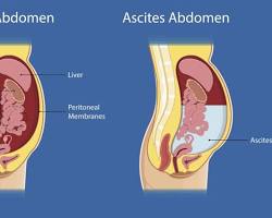 Image of medical health risks of abdominal belly fat diagram or photo