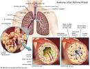 Asthmatic Bronchitis: Symptoms, Treatment, and More