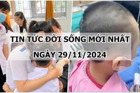 Tin tức đời sống 29/11/2024: Nguyên nhân khiến bé 7 tuổi bị hoại tử da đầu