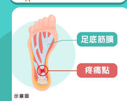 足底筋膜の画像