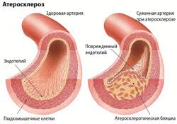 Результат пошуку зображень за запитом "атеросклероз венечных артерий"