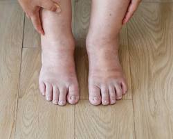 Swollen ankles and feet due to kidney disease