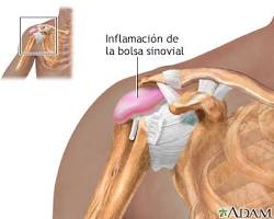 Imagen de Bursitis de hombro