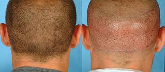 http://www.hairtransplantationcevre.com/