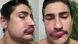 Influencer internado espremeu espinha no 'triângulo da morte'; veja riscos