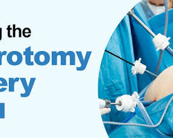 Image of Laparotomy Tenders
