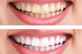 teeth whitening के लिए चित्र परिणाम