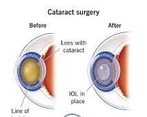 Зображення: Cataract surgery