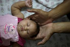 Image result for images of zika babies