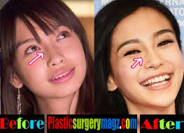 Resultado de imagem para before after surgery