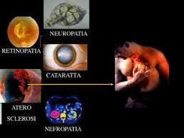 Image result for neuropatia diabetike