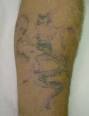 Getting tattooed while taking Accutane? - Accutane (isotretinoin)