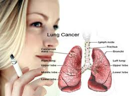 Hasil gambar untuk 7 gejala kanker paru-paru