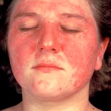 Image result for penyakit lupus