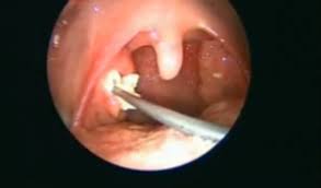 Image result for tonsil stones