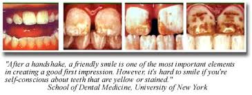 Image result for fluorosis