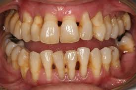 Resultat d'imatges de periodontitis