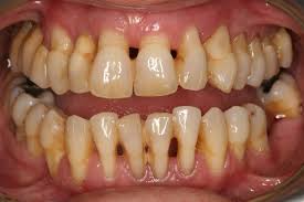 Resultat d'imatges de periodontitis