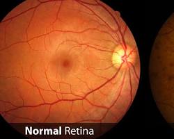 Image of Diabetic retinopathy