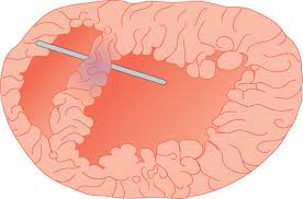 Image result for Infarction