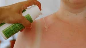 Beat the Burn: Tips for Soothing Sunburn with The Weather Channel - 1