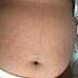 Doctors detail skin rash on first Miami pregnant woman with Zika