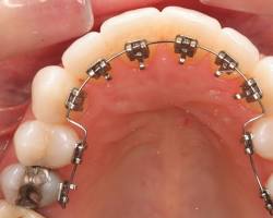 Image of Lingual Braces