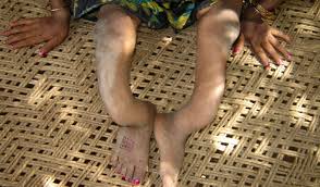 Image result for fluorosis