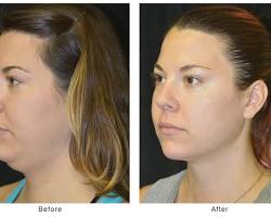 Image of double chin removal before and after results